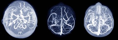 Beynin MRI ve MRA & MRV 'si. Sol tarafa 0.7 cm' lik orta çizgi kaymasıyla orta dereceli vasojenik ödem..
