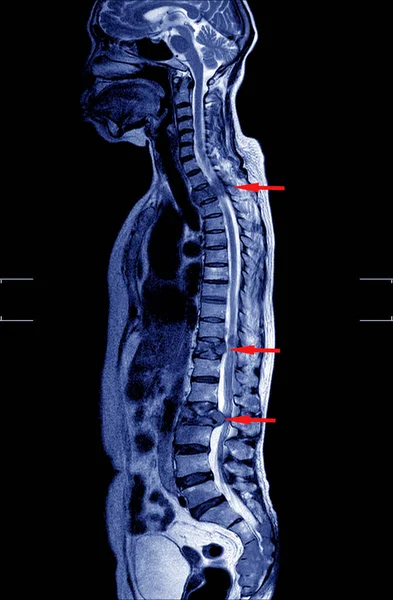 Mri Thoracolumbar Spine Υπάρχει Μειωμένη Οσφυϊκή Λόρδωση Χωρίς Σπονδυλολίσθηση Μέτρια — Φωτογραφία Αρχείου