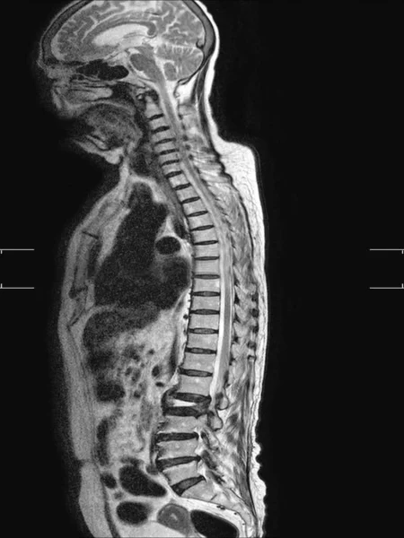 척추뼈 Mri 척추가 것으로 나타났다 디스크 심하게 줄어든 것으로 나타났고 — 스톡 사진