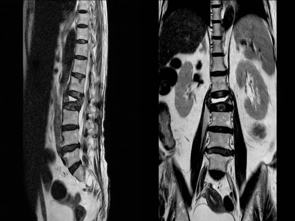 MRI of lumbar spine The study reveals burst fracture of L2 vertebral body, appears as severe decreased disc height and widening of interpedicular distance.