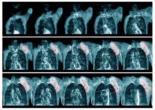 Imágenes Por Resonancia Magnética Izquierda Antecedentes Hombro Caso Teniente Masa — Foto de Stock