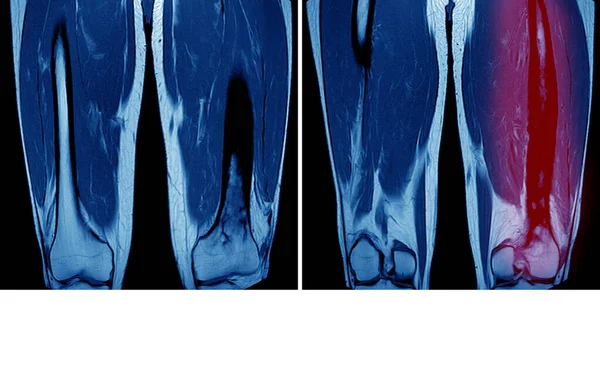 Her Iki Uyluk Kemiğinin Manyetik Rezonans Görüntülemesi Mri Zlenim Kronik — Stok fotoğraf