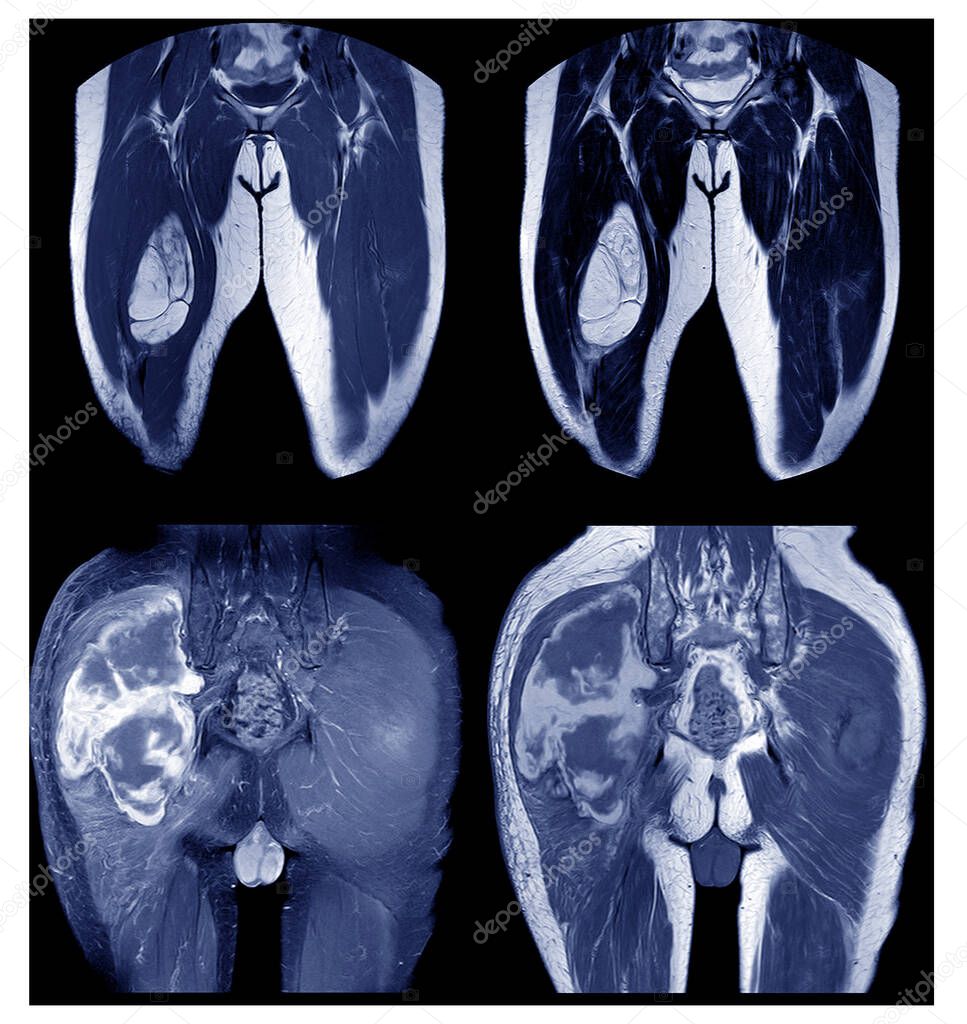 Magnetic Resonance Imaging collection images with a lump in the hip area.