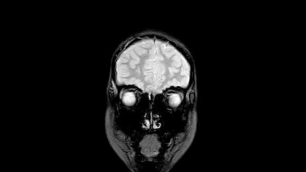 MRI OF THE BRAIN A BOY 8 YEAR OLD HISTORY: Bolest hlavy po dobu 3 dnů Nalezení velkého akutního parenchymálního krvácení s malou porcí subakutního stádia se zaměřením na bílou hmotu a mírné postižení kůry mozkové — Stock video