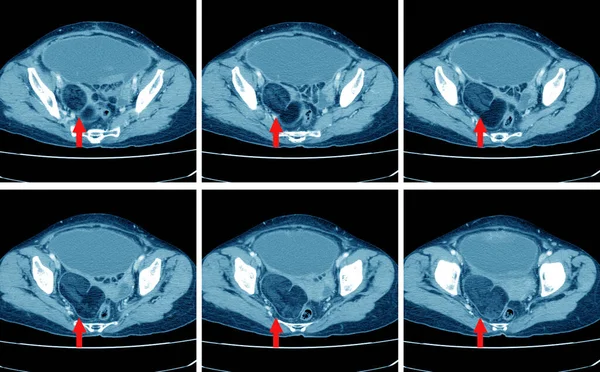 Tomografi Karın Bölgesinin Tamamı Adnexa Kireçlenmiş Yağ Kütlesi Buldu Dermoid — Stok fotoğraf