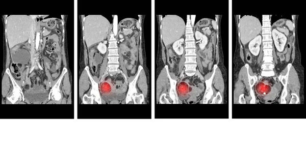 Whole Abdomen Finding Fatty Mass Calcification Adnexa Representing Dermoid Cyst — Stock Photo, Image