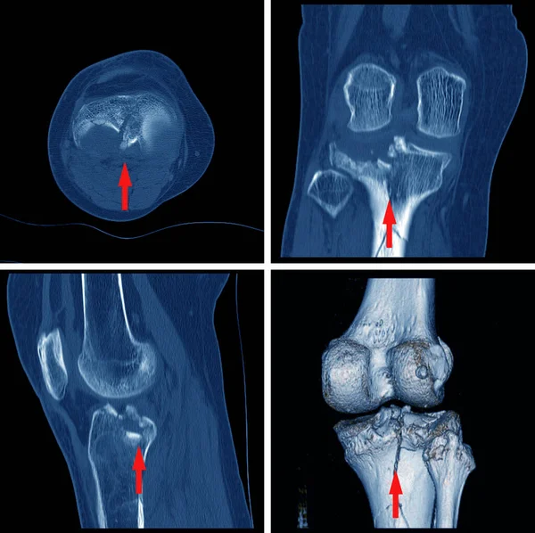 Knee Fracture Intercondylar Eminence Tibia Compression Fracture Posterior Lateral Tibial — Stock Photo, Image