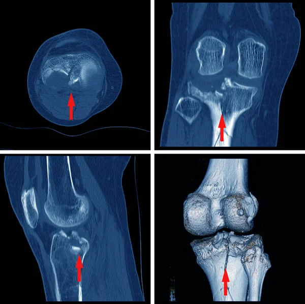 Коліно Перелом Міжхребцевої Видимості Великогомілкової Кістки Перелом Стиснення Задньої Частини — стокове фото