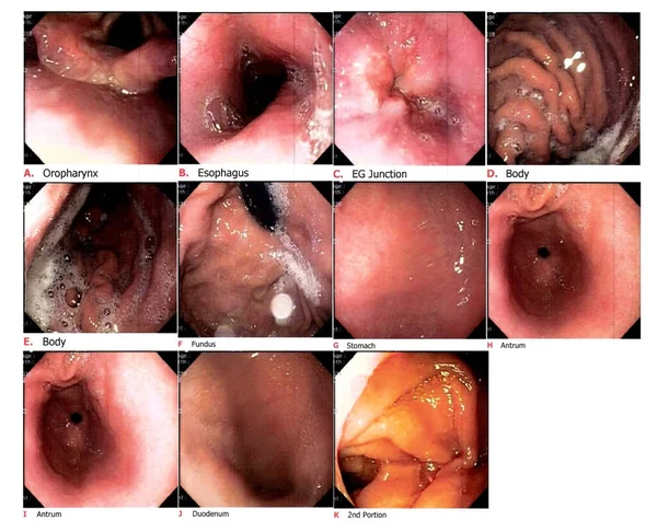Tıbbi görüntü Gastrointestinal endoskopik muayene görüntüsü kronik gastriti gösteriyor. Tıbbi sağlık konsepti.