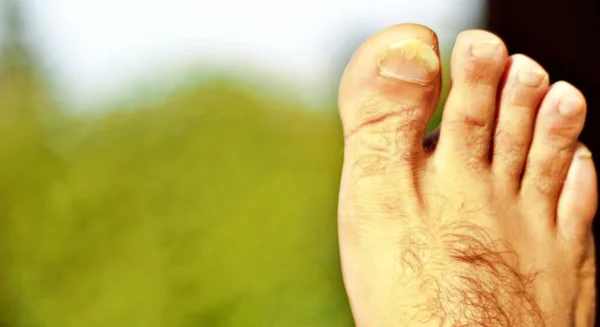 Moche Ongles D Orteils Images Libres De Droit Photos De Moche Ongles D Orteils Depositphotos