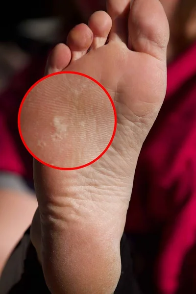 Blisters on the feet Burns, skin abrasions, Scabs Are Dry