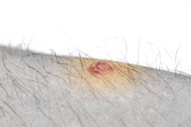 Kıllı bir insan vücudunda yakın plan siğil, ön ve arka plan bulanıklığı