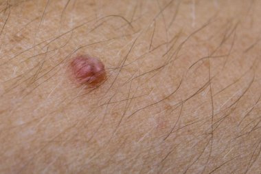 Kıllı bir insan vücudunda yakın plan siğil, ön ve arka plan bulanıklığı