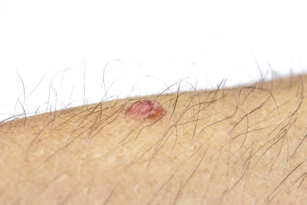 Close-up wart on a hairy human body, front and background blurre — Stock Photo, Image