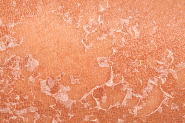 Peeling of skin after burned by sunlight — Stock Photo, Image