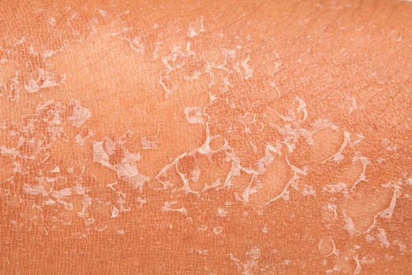 güneş ışığı tarafından yaktıktan sonra cilt soyma