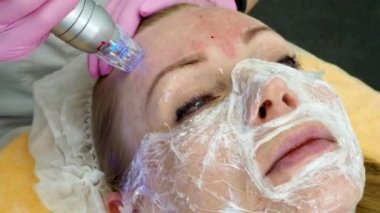 Kısmi mikro frekans aygıtı. Güzellik uzmanı, radyoaktivite iğnesini kullanarak cilt yenileme yapıyor. 4K