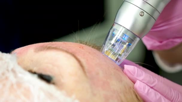 Apparecchiature Frazionarie Radiofrequenza Microneedle Estetista Facendo Rimodellamento Della Pelle Utilizzando — Video Stock