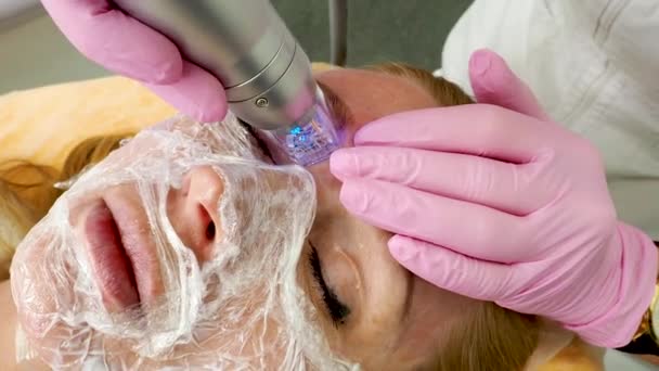 分数微调射频装置 美容师用射频针头拔出进行皮肤再造 — 图库视频影像