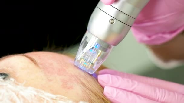 Aparato Fraccional Radiofrecuencia Con Micronúcleo Esteticista Haciendo Remodelación Piel Usando — Vídeos de Stock