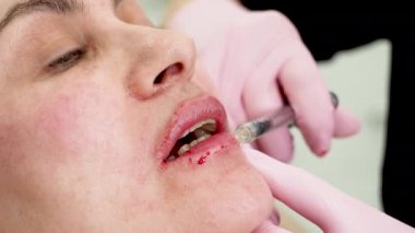 Güzellik salonunda şırınga tedavisiyle hyaluronik botoks asidi kaldıran olgun kadın dudaklarına yakın çekim. Güzellik konsepti