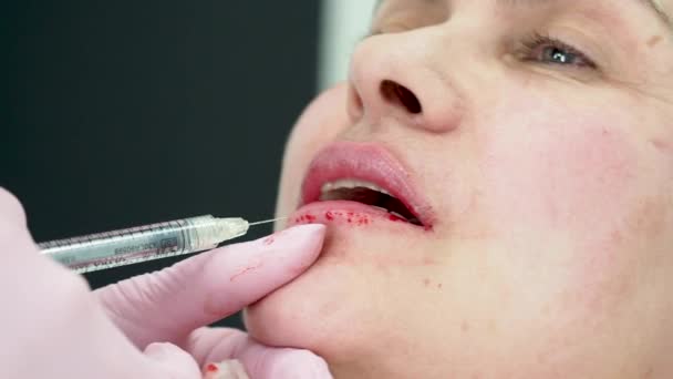 Nahaufnahme Reifer Weiblicher Lippen Mit Hyaluronsäure Botox Lifting Durch Spritzenbehandlung — Stockvideo