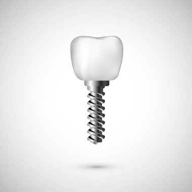 Beyaz gerçekçi diş implantı. Beyaz arka planda diş bakımı ve diş hekimliği geçmişi var. Vektör 