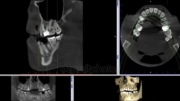 Real life MRI scan čelistí člověka pro stomatologii zubař výzkum nová kvalita lékařské vědy zubní záběry animace obrazovka — Stock video