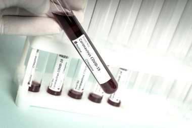 Elinde kan örneği içeren bir test tüpü var. Covid-19 koronavirüs analizi için test tüpü. Laboratuvar test hastaları örneği