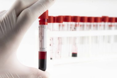 Elinde kan örneği içeren bir test tüpü var. Covid-19 koronavirüs analizi için test tüpü. Laboratuvar test hastaları örneği