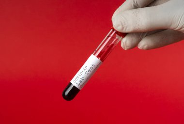 Elinde kan örneği içeren bir test tüpü var. Covid-19 koronavirüs analizi için test tüpü. Laboratuvar test hastaları örneği