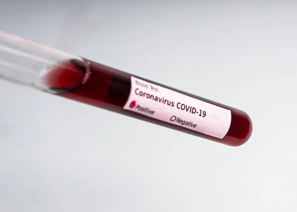 Vérmintát Tartalmazó Kémcső Covid Coronavirus Analizáló Kémcsővel Laboratóriumi Vizsgálati Betegek — Stock Fotó