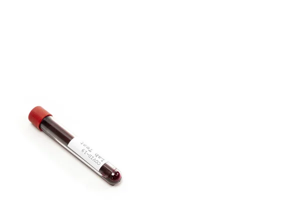 Vérmintát Tartalmazó Kémcső Covid Koronavírus Analizáló Kémcső Laboratóriumi Vizsgálati Betegek — Stock Fotó