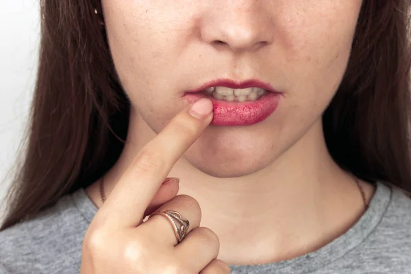Güzel güzel bir kadın portresi yakından virüslü herpes virüsü dudakları.