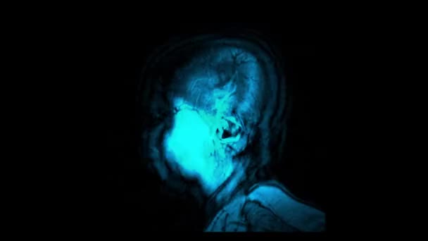 Hjernen Computer Tomografi Resultat Visualisering Lodrette Dias Menneskelige Hoved Screening – Stock-video
