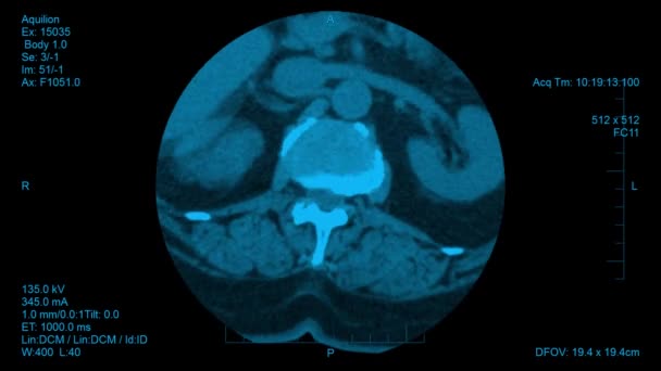 Vizualizace Výsledků Páteřní Počítačové Tomografie Horizontální Snímky Screeningu Páteřního Disku — Stock video