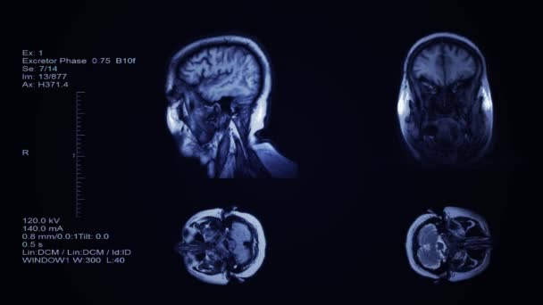 Visualização Resultado Tomografia Computadorizada Cabeça Cérebro Quatro Lâminas Divisórias Triagem — Vídeo de Stock