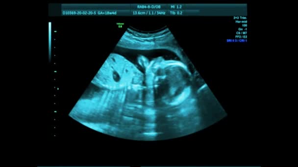 Écran de balayage d'ordinateur d'embryon fonte. Visualisation de la technologie des soins de grossesse et de maternité 