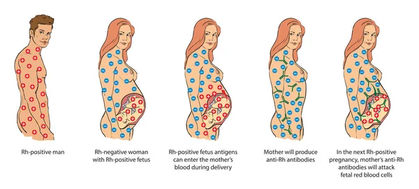 Rh - faktor příklad — Stockový vektor