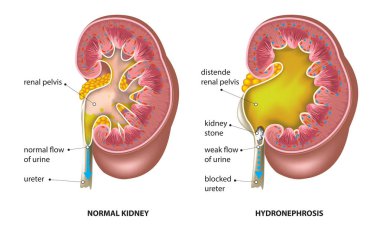 böbrek taşı - hydronephrosis