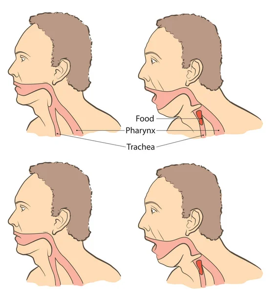 S'étouffer avec de la nourriture — Image vectorielle