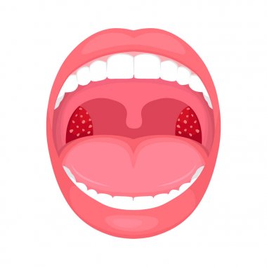  vector illustration of a throat bacterial and viral infection, tonsils inflammation. clipart