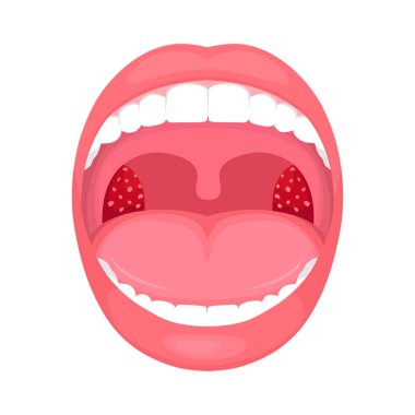  vector illustration of a throat bacterial and viral infection, tonsils inflammation. clipart