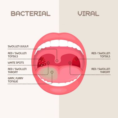 vector illustration of a throat bacterial and viral infection, tonsils inflammation. clipart
