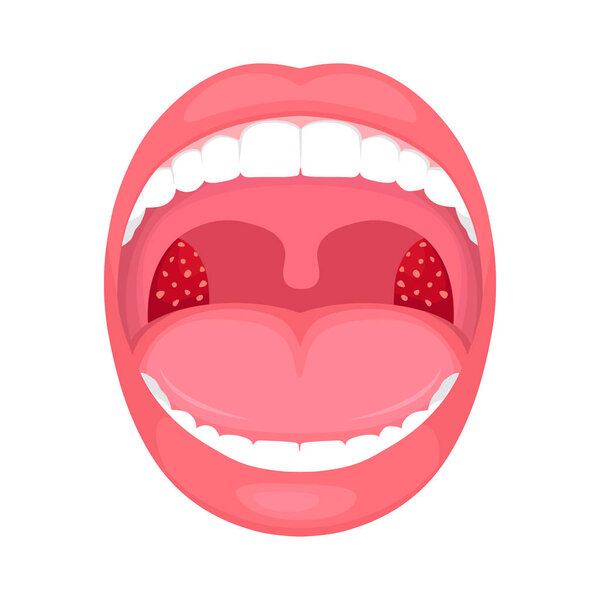  vector illustration of a throat bacterial and viral infection, tonsils inflammation.