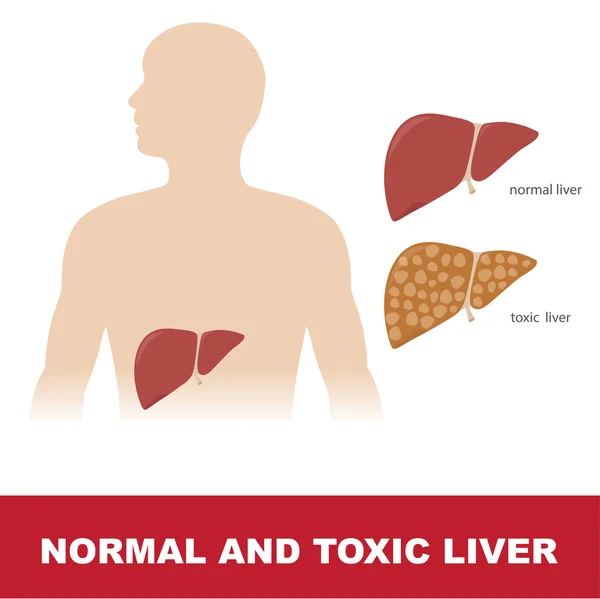 Comparación hepática normal y tóxica — Archivo Imágenes Vectoriales