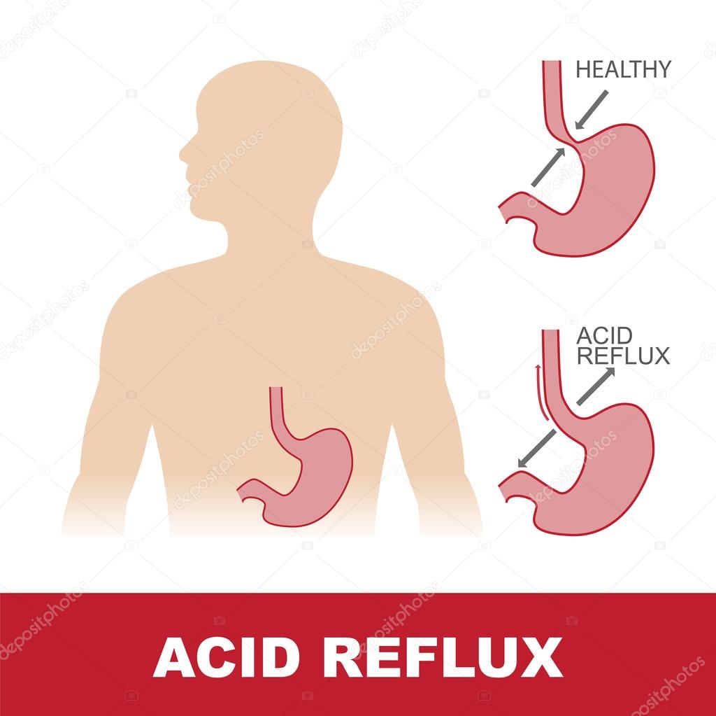 acid reflux stomach disease