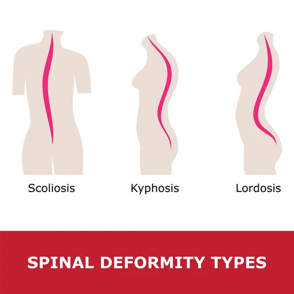 Spinal deformite türleri
