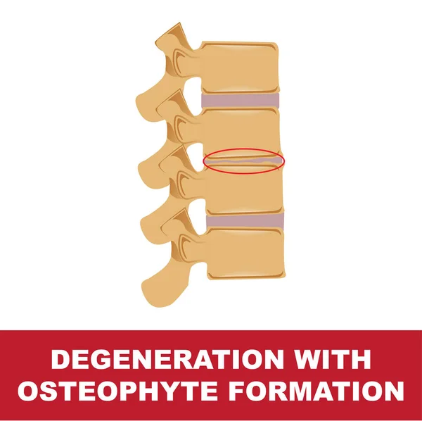 Osteophyte 디스크 변성 — 스톡 벡터