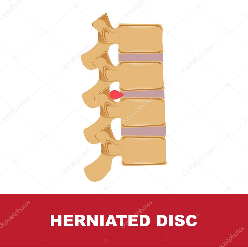 herniated disc vector illustration